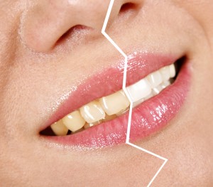 Piaskowanie to zabieg polegający na usunięciu osadu z zębów