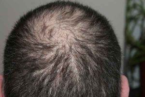 Mikropigmentacja skóry głowy - innowacyjne rozwiązanie dla problemu łysienia